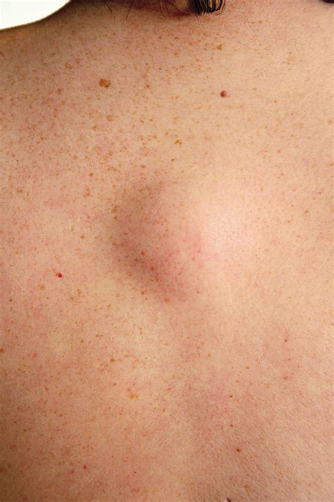 There&39;s a very small chance that a lump resembling a lipoma may actually. . Lipoma groin reddit